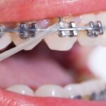 Стоимость брекетов в Америке: полный обзор цен и факторов, влияющих на стоимость